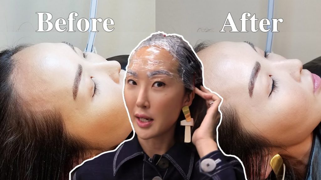 I Got My Hairline Microbladed for my Receding Hairline