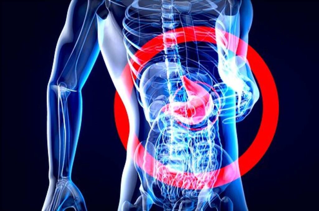 What Is Intussusception