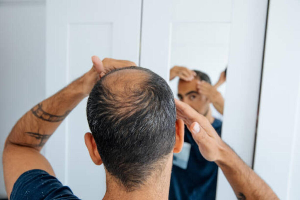 Natural cures for Men's Hair Loss